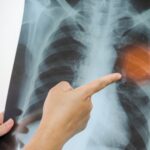 Is Pneumonia or Bronchitis Contagious? 7 Natural Remedies to Soothe Your Lungs