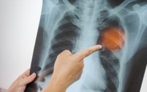 Articles by Suzy Cohen, America’s Pharmacist® 45 pneumonia