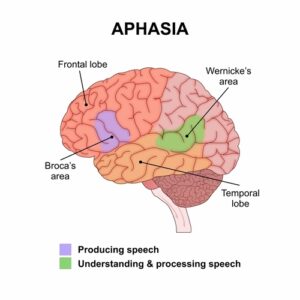 Image of brain showing areas of aphasia