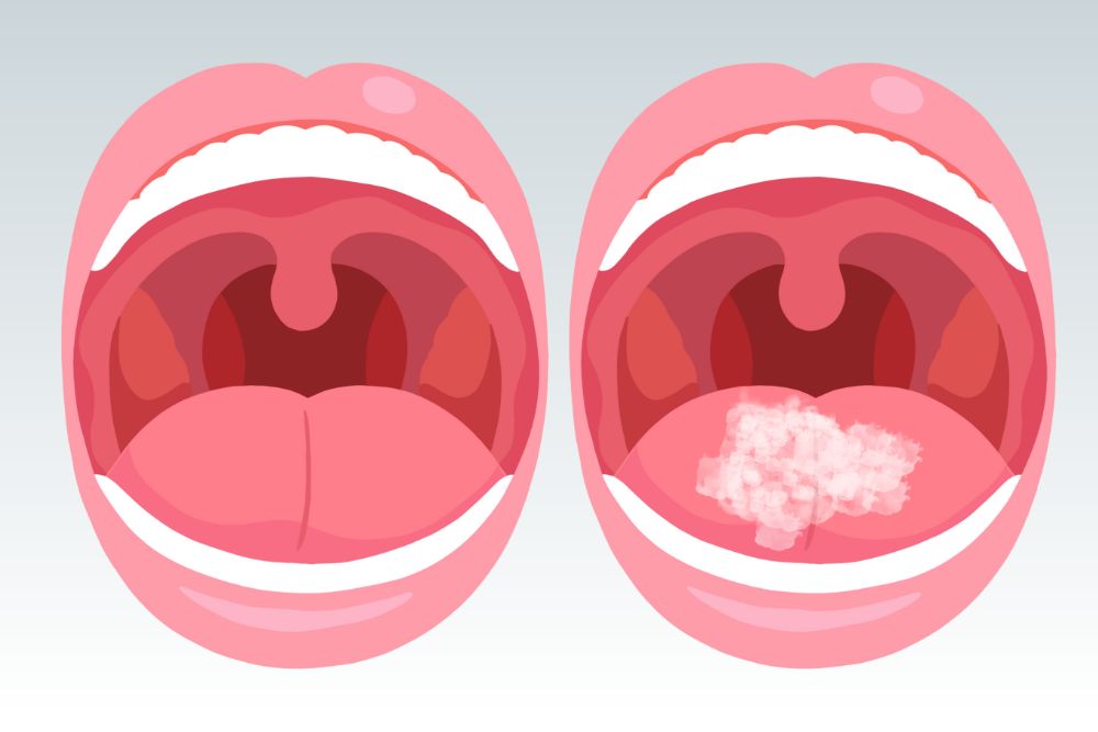 Read more about the article 7 Common Reasons You Develop Oral Thrush (And How to Treat It Naturally and Medically)