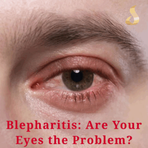 Blepharitis Are Your Eyes the Problem