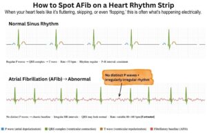 Normal vs AFib on a heart strip