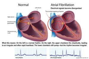 Diagram showing AFib vs normal heart rhythm