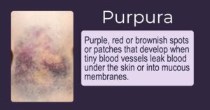 purpura definition for easy bruising